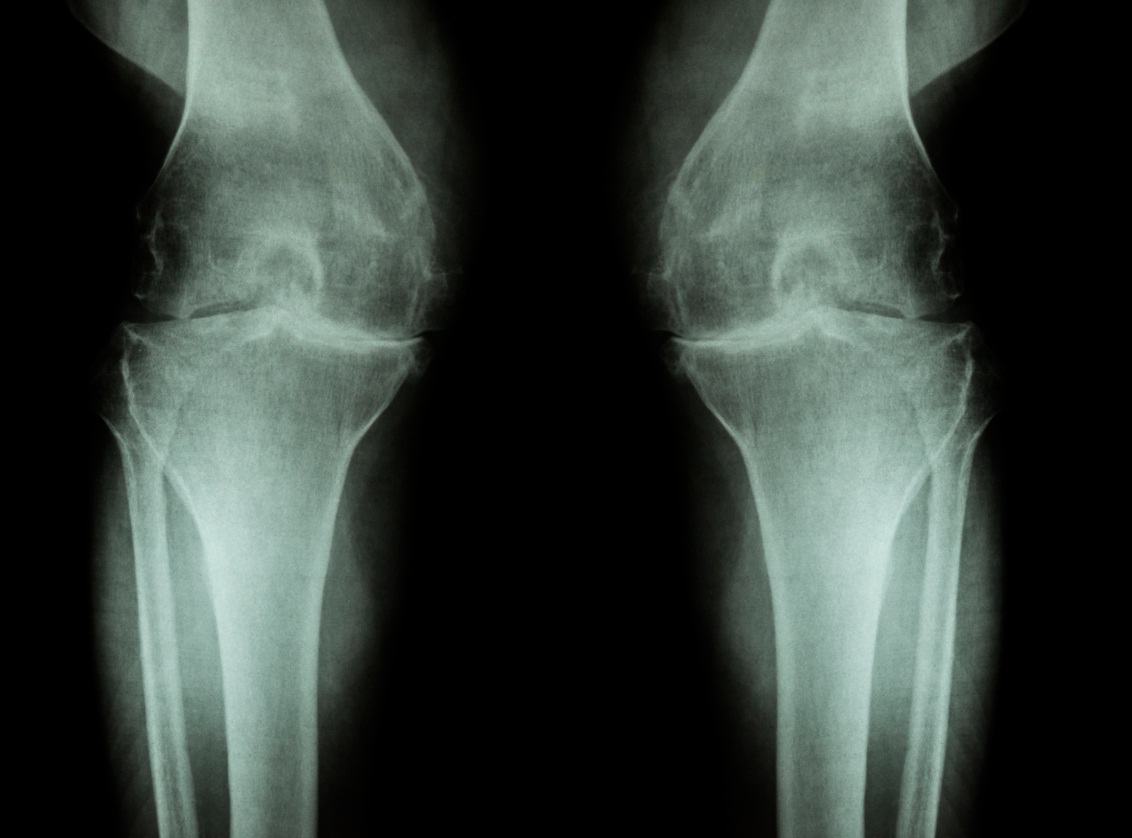 Vaginal Tissue Erosion Injury Attorney Leifer Law Firm