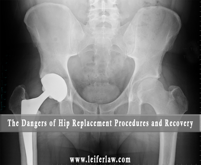 The Dangers of Hip Replacement Procedures and Recovery