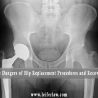 hip replacement surgery and recovery