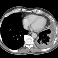 Mesothelioma You Need to Know