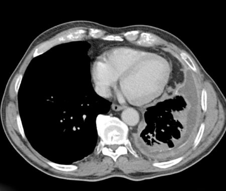 Mesothelioma You Need to Know Mesothelioma You Need to Know