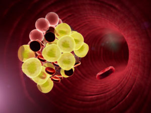 Myths About IVC Filter Injuries Myths About IVC Filter Injuries