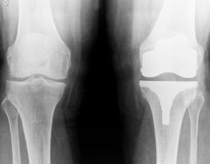 knee x-ray