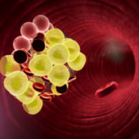 Leifer-Why-The-Biggest-Myths-About-IVC-Filter-Injuries-May-Actually-Be-Right Leifer-Why-The-Biggest-Myths-About-IVC-Filter-Injuries-May-Actually-Be-Right