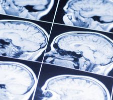 BrainInj3 BrainInj3