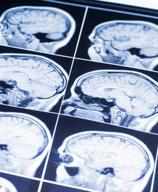 BrainInj3 BrainInj3